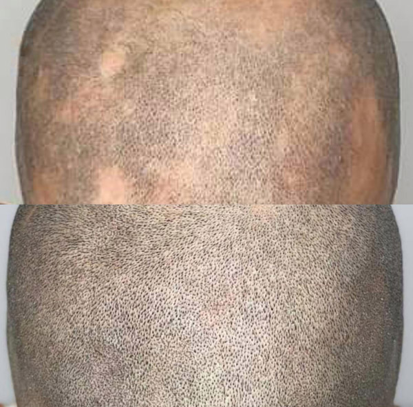 Scalp Micropigmentation