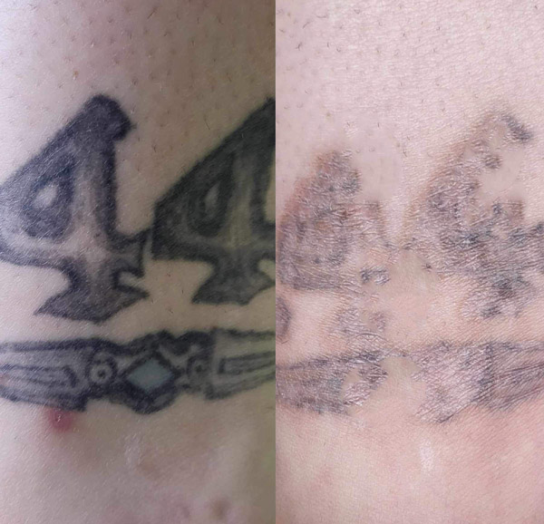 Non-Laser Tattoo Removal